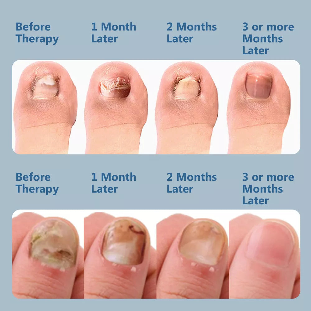 Nail Fungus Laser Treatment Device Dual Wavelength Therapy