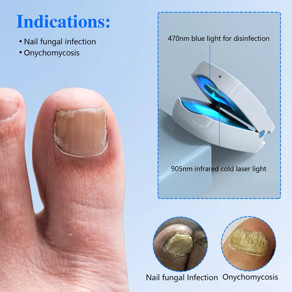 Nail Fungus Laser Treatment Device Dual Wavelength Therapy