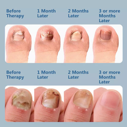 Nail Fungus Laser Treatment Device Dual Wavelength Therapy