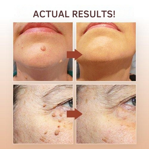 Plant-Based Wart and Skin Spot Remover Pen with Precision Applicator