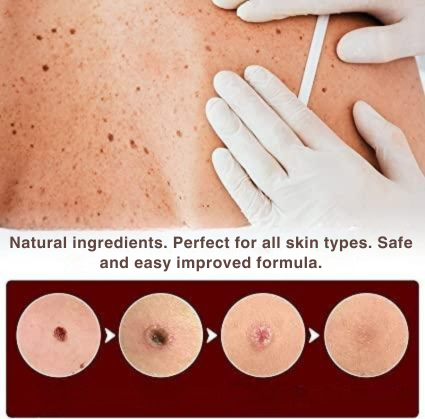 Plant-Based Wart and Skin Spot Remover Pen with Precision Applicator