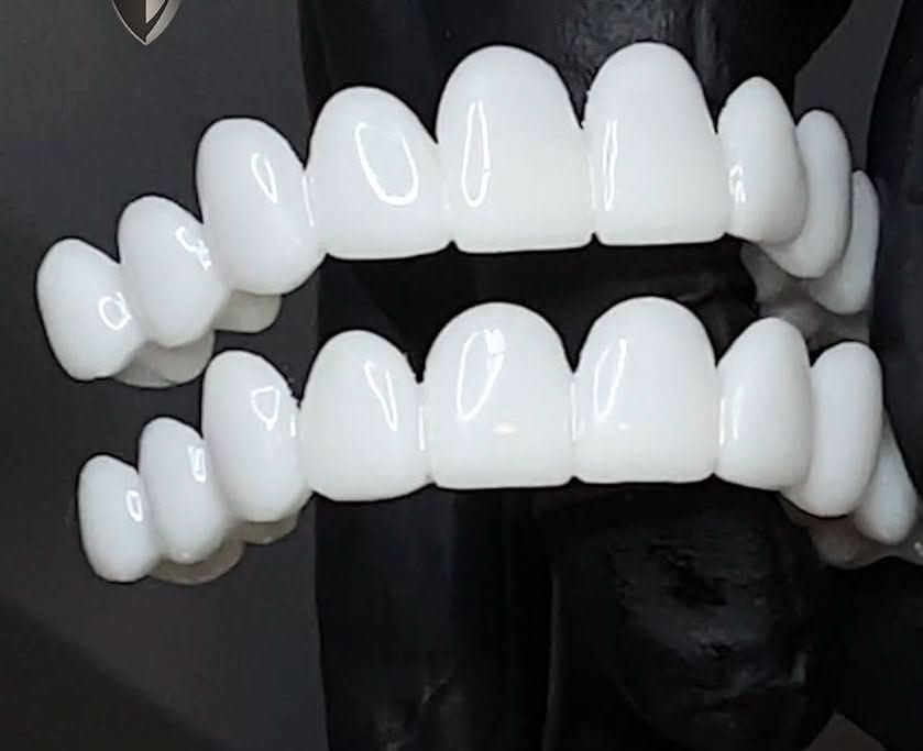 Removable Dental Veneer Prosthesis with White Tooth Appearance